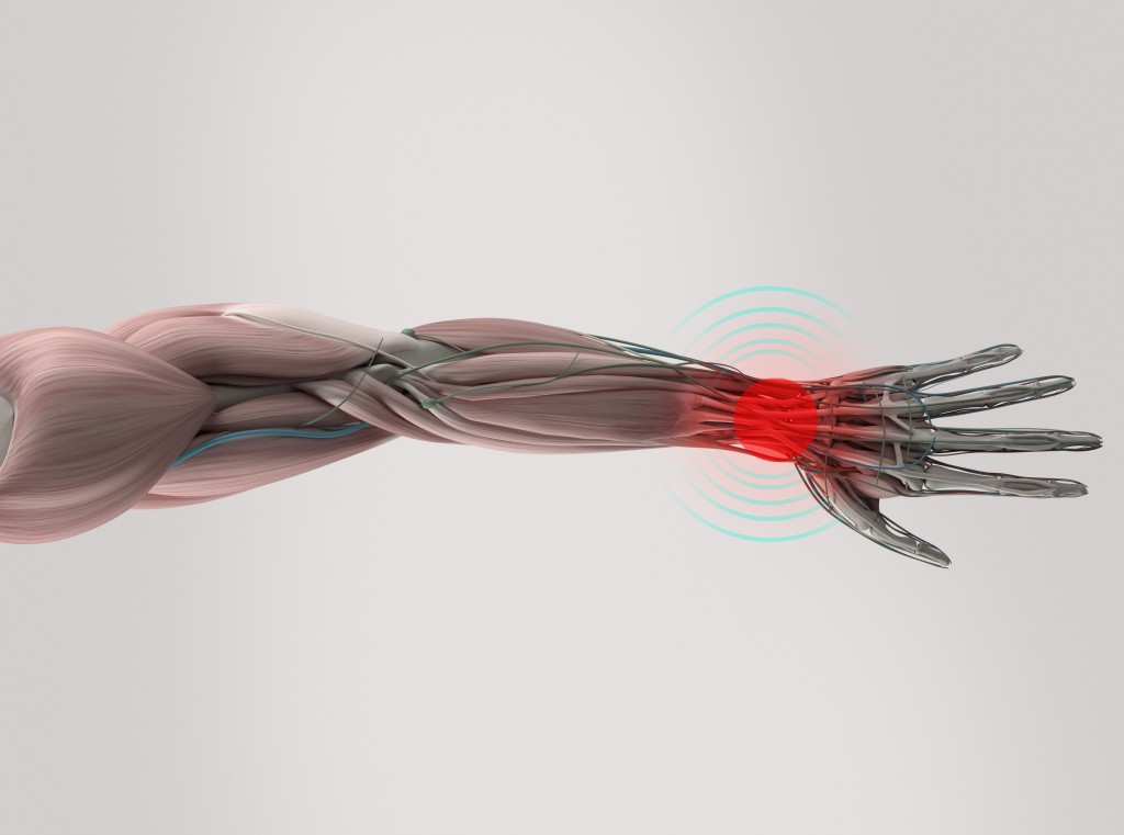 What Causes Carpal Tunnel? - TMIHI